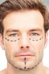Special Considerations for Male Facelifts
