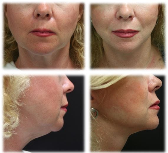 Dr. Thomassen Facelift Fort Lauderdale