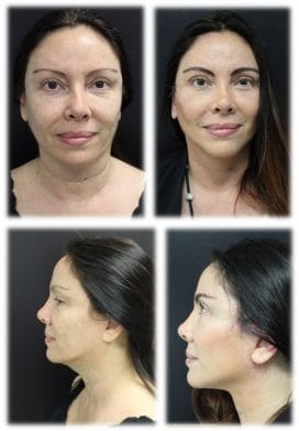 Facelift before and afters