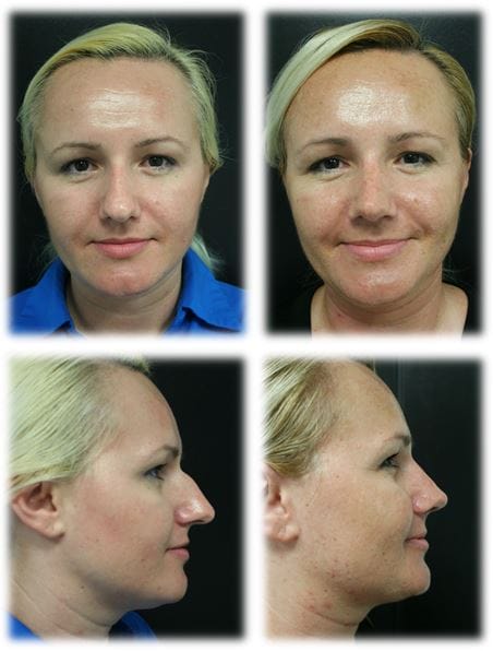 Rhinoplasty Before and Afters