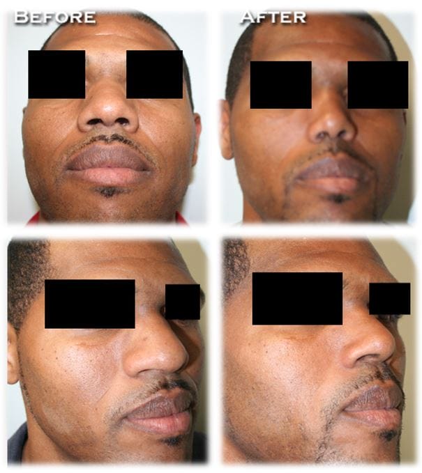 African American Rhinoplasty by Dr. Thomassen in Fort Lauderdale