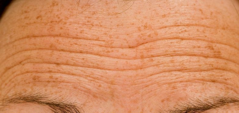 Forehead wrinkles ideal for treatment with botulinum toxin