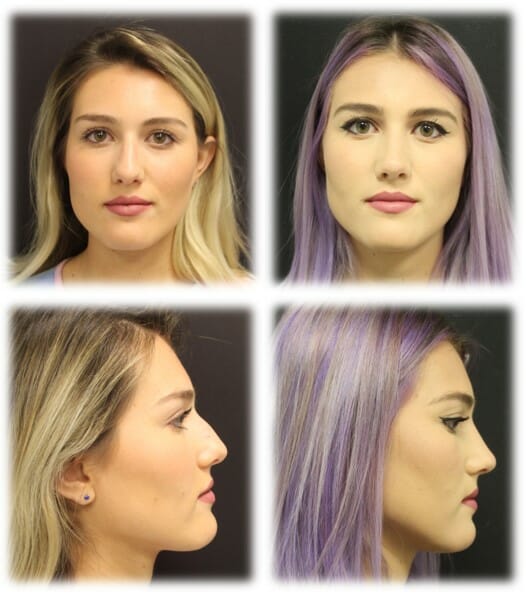 Rhinoplasty Before and Afters