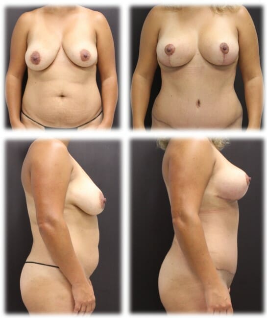 Mommy Makeover (Abdominoplasty and Breast Lift) by Dr. Thomassen in Fort Lauderdale