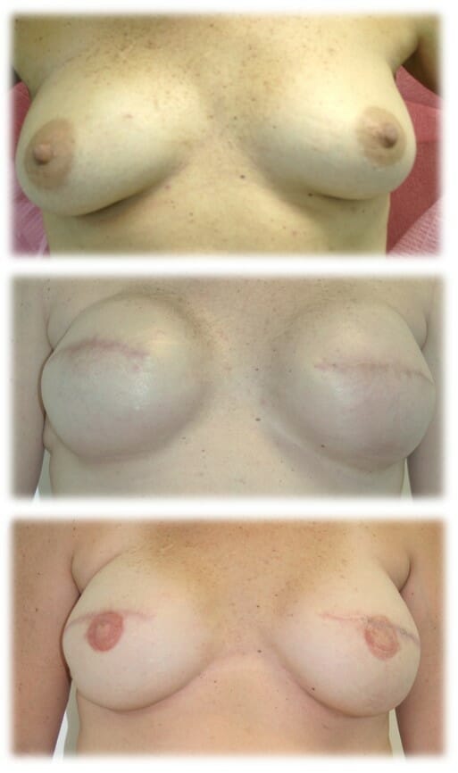 Bilateral Breast Reconstruction with Staged Expander - Implant, Nipple Reconstruction and Areolar Tattoo by Dr. Thomassen