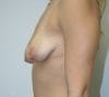 Tuberous Breast Deformity