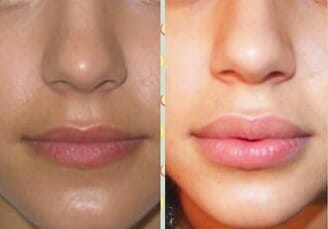 Circumferential Abdominoplasty by Dr. Thomassen in Fort Lauderdale