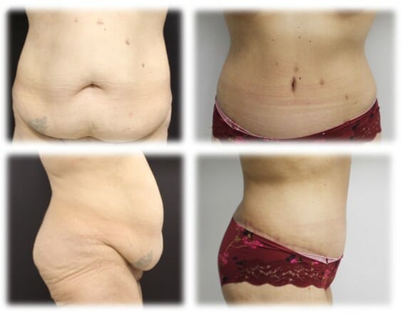 Circumferential Abdominoplasty by Dr. Thomassen in Fort Lauderdale