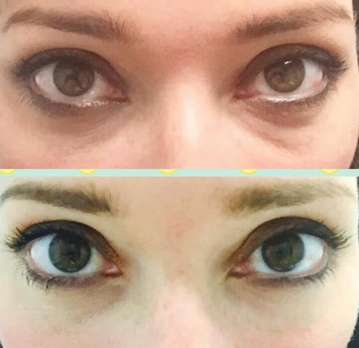 Tear trough filler with Dr. Thomassen in Fort Lauderdale