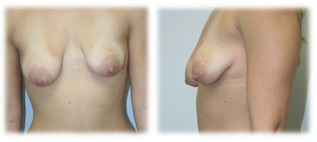 Tuberous or constricted breast deformity