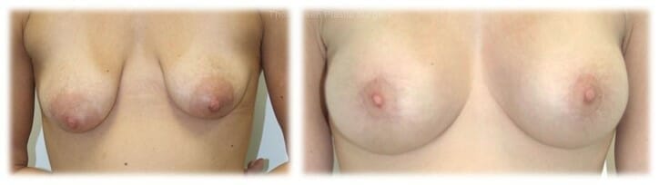 Breast Lift with implant by Dr. Thomassen for correction of tuberous breast deformity