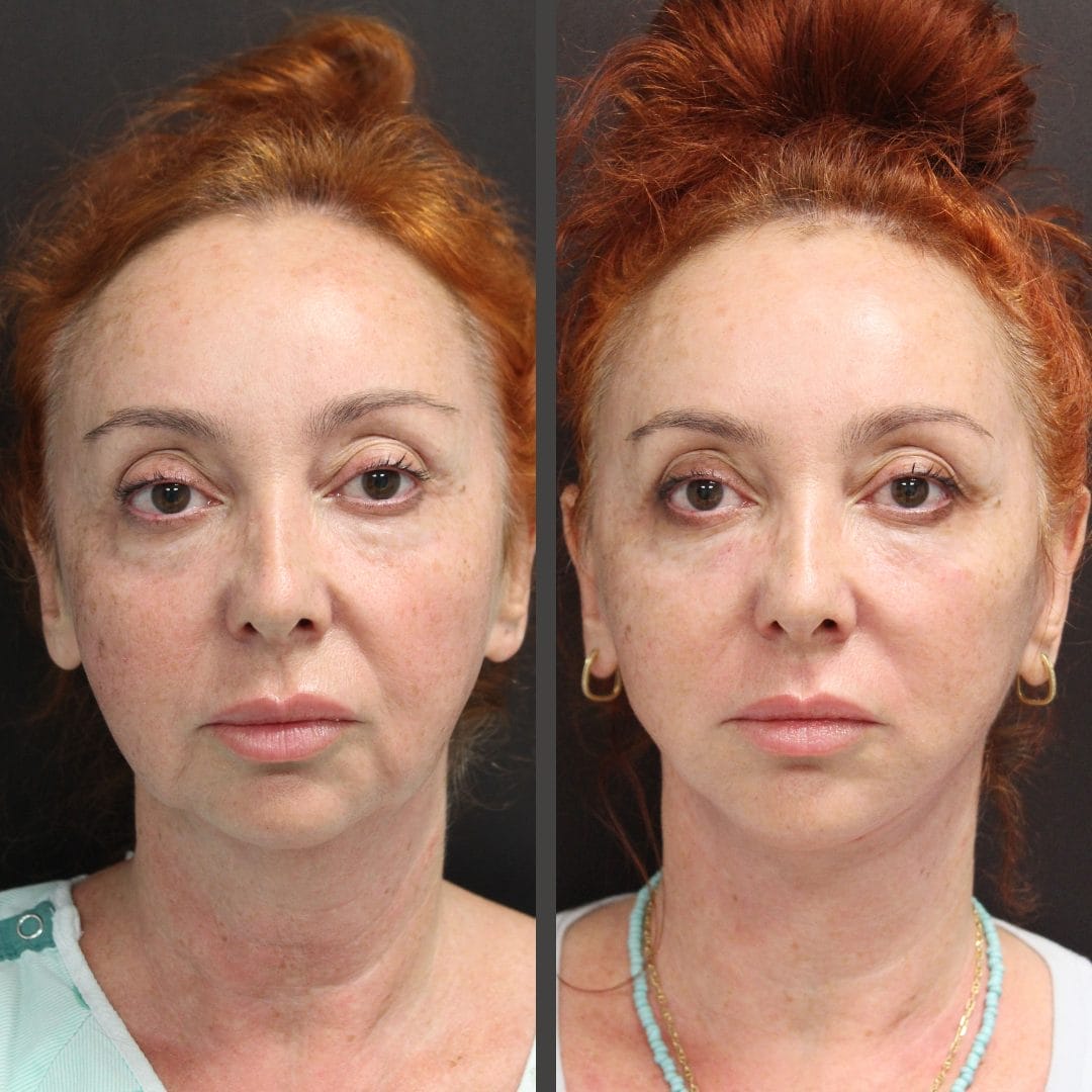 Face and Neck Lift before and after by Dr. Thomassen in Fort Lauderdale