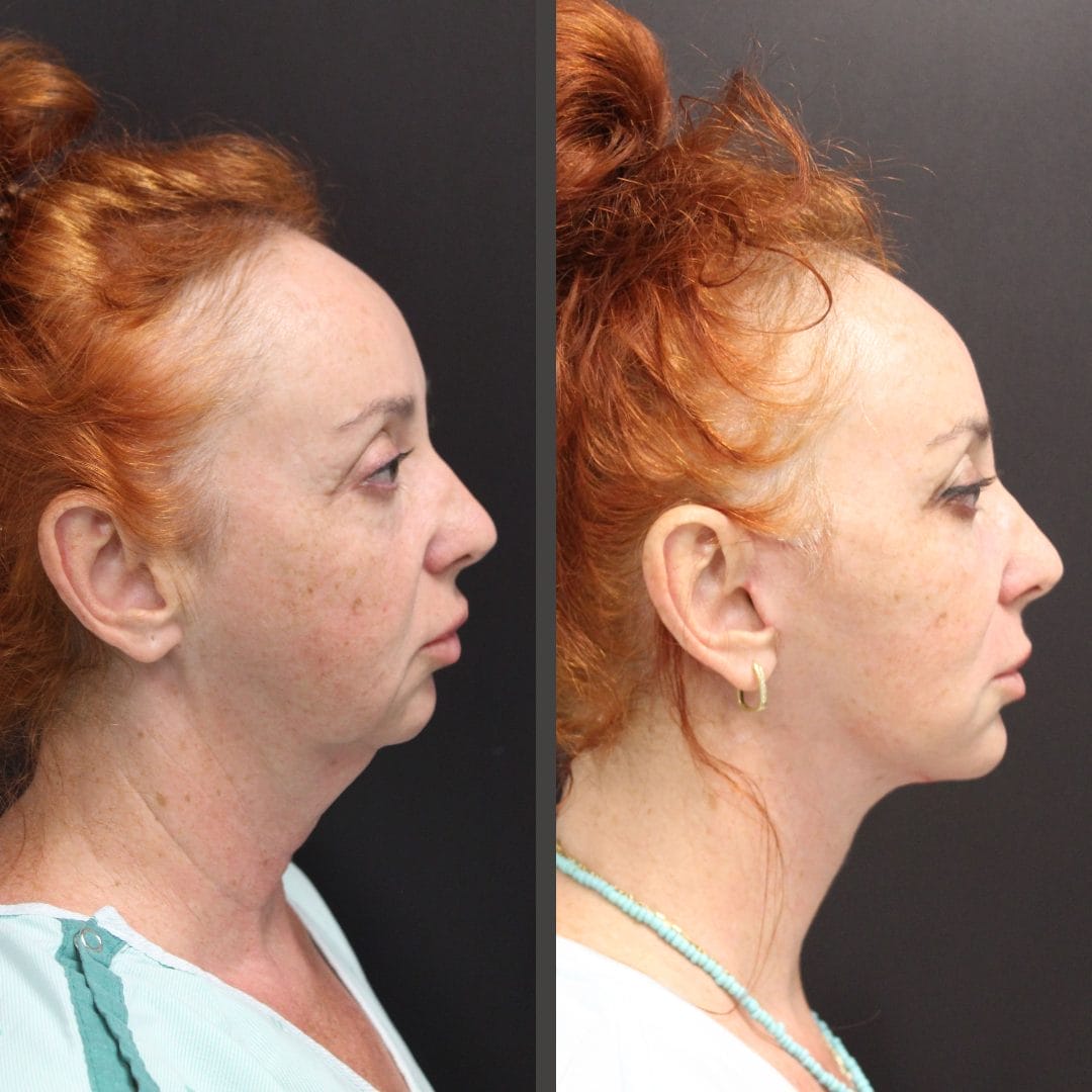 Face and Neck lift before and after by Dr. Thomassen in Fort Lauderdale