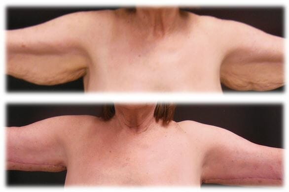 Brachioplasty by Dr. Thomassen