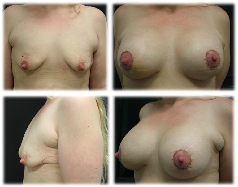 Augmentation Mastopexy by Dr. Thomassen