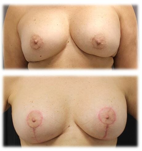 Augmentation Mastopexy by Dr. Thomassen