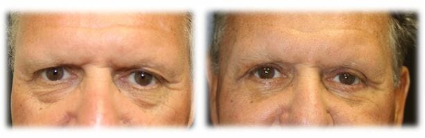 Blepharoplasty before and afters