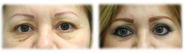Blepharoplasty before and afters