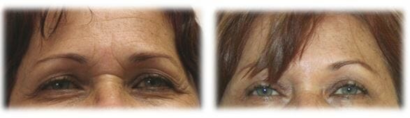 Blepharoplasty before and afters