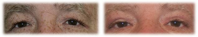 Bleph Upper10 Eyelid Surgery: Upper lid blepharoplasty