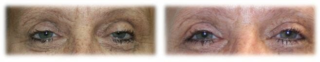Bleph Upper11 Eyelid Surgery: Upper lid blepharoplasty