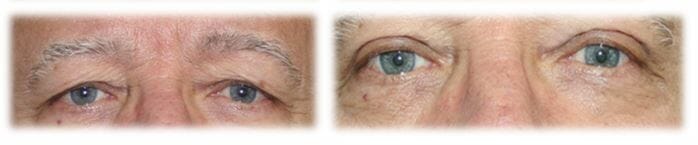 Eyelid Surgery: Upper lid blepharoplasty