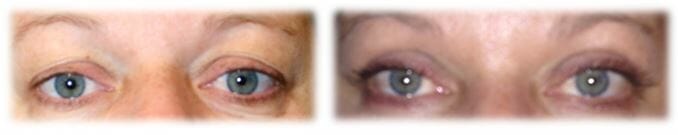 Eyelid Surgery: Upper lid blepharoplasty