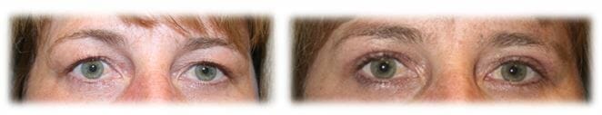 Eyelid Surgery: Upper lid blepharoplasty