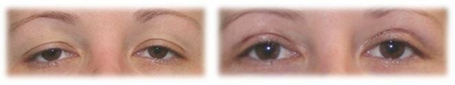 Bleph Upper16 Eyelid Surgery: Upper lid blepharoplasty