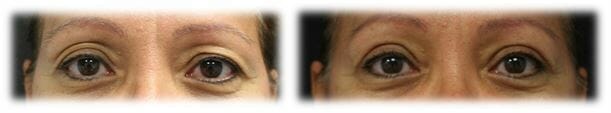 Bleph Upper17 Eyelid Surgery: Upper lid blepharoplasty