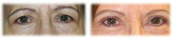 Bleph Upper18 Eyelid Surgery: Upper lid blepharoplasty