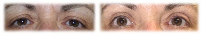 Bleph Upper19 Eyelid Surgery: Upper lid blepharoplasty
