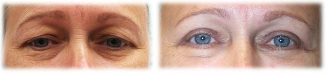 Eyelid Surgery: Upper lid blepharoplasty