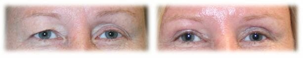 Eyelid Surgery: Upper lid blepharoplasty