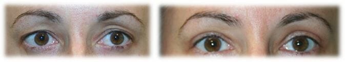 Bleph Upper21 Eyelid Surgery: Upper lid blepharoplasty