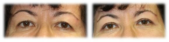 Bleph Upper22 Eyelid Surgery: Upper lid blepharoplasty