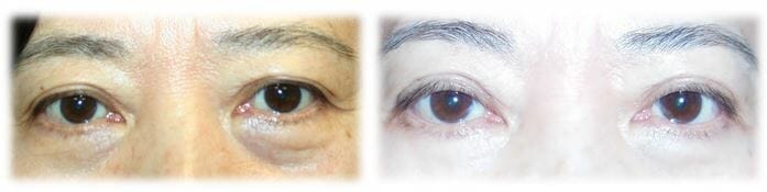 Bleph Upper23 Eyelid Surgery: Upper lid blepharoplasty