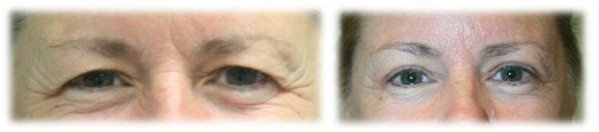 Bleph Upper24 Eyelid Surgery: Upper lid blepharoplasty