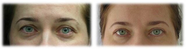 Eyelid Surgery: Upper lid blepharoplasty