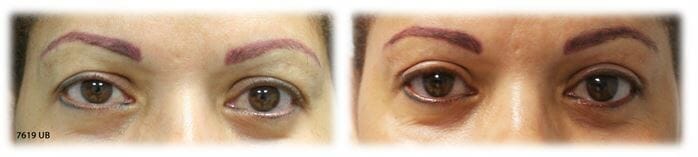 Bleph Upper31 Eyelid Surgery: Upper lid blepharoplasty