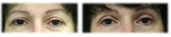 Eyelid Surgery: Upper lid blepharoplasty
