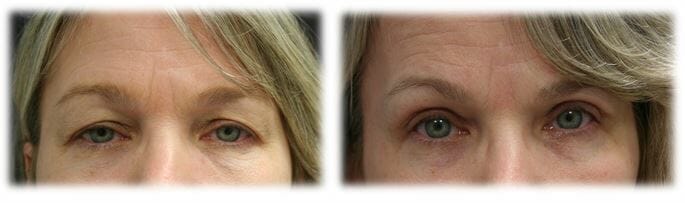 Blepharoplasty before and afters