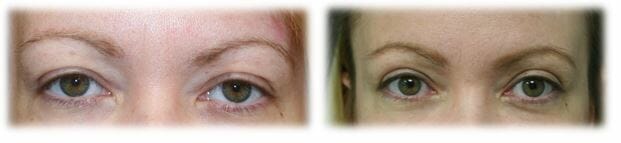 Bleph Upper35 Eyelid Surgery: Upper lid blepharoplasty