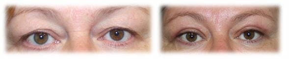 Eyelid Surgery: Upper lid blepharoplasty