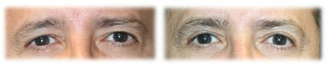Bleph Upper37 Eyelid Surgery: Upper lid blepharoplasty