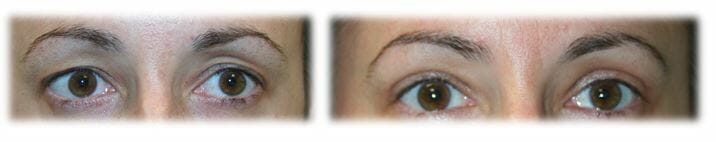 Bleph Upper38 Eyelid Surgery: Upper lid blepharoplasty