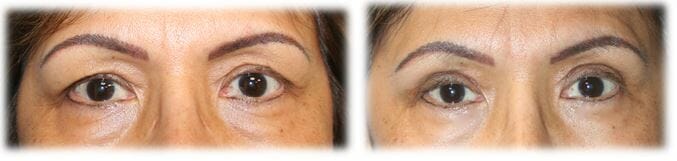 Bleph Upper39 Eyelid Surgery: Upper lid blepharoplasty