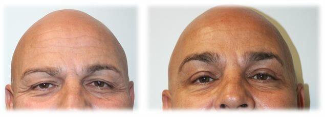 Bleph Upper4 Eyelid Surgery: Upper lid blepharoplasty