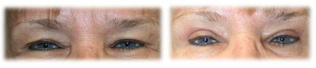 Bleph Upper41 Eyelid Surgery: Upper lid blepharoplasty