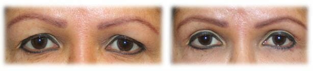 Eyelid Surgery: Upper lid blepharoplasty
